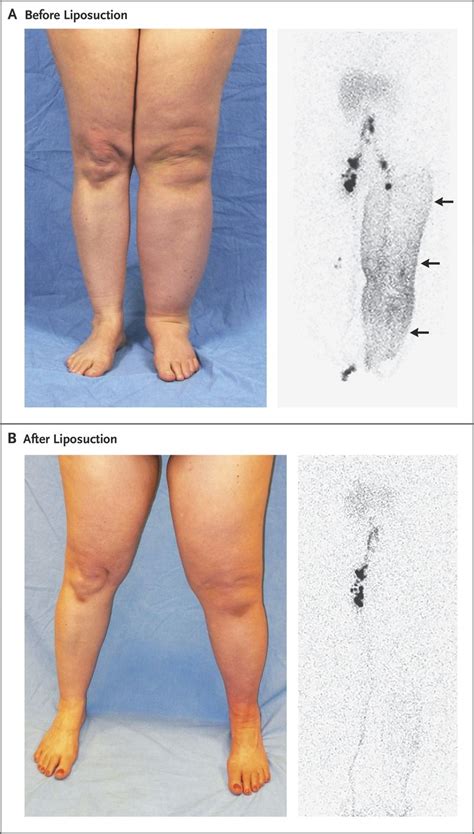 Pin On Lymphedema Lipedema