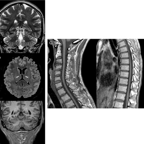 Brain And Spinal Cord Mri Findings In Two Patients Patient 2 A D