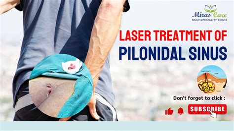 Laser Treatment Of Pilonidal Sinus By Dr Mir Asif Rehman Pilonidal