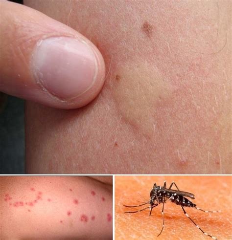 Alergias Por Picaduras De Insectos Conoce Sus Causas Y Consecuencias