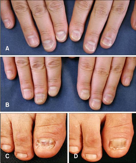 A A 40 Year Old Female Presented With Distal Separation Of Nail
