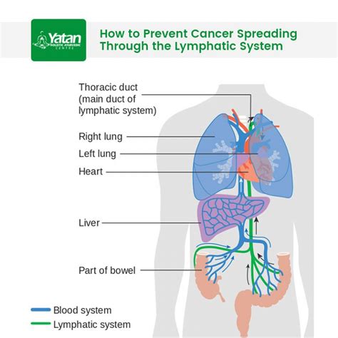 How To Prevent Cancer Spreading Through The Lymphatic System