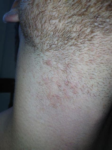 I Get This Rash On My Neck Every Time I Shave Anyone Know What It Is