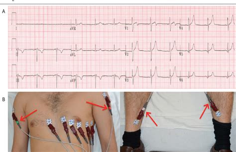 Figure 1 From Common Ecg Lead Placement Errors Part I Limb Lead