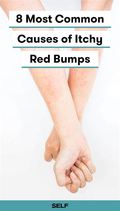 Itchy Bumps On The Skin Can Be A Sign Of A Number Of Skin Issues Like Eczema Or Dermatitis