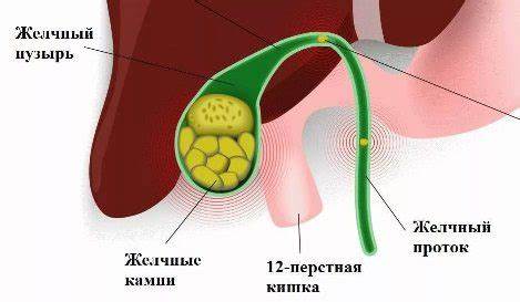 Холецистит симптомы лечение диета хронический Гострий і хронічний холецистит Гострий і хронічний холецистит Холецистит симптомы лечение диета хронический