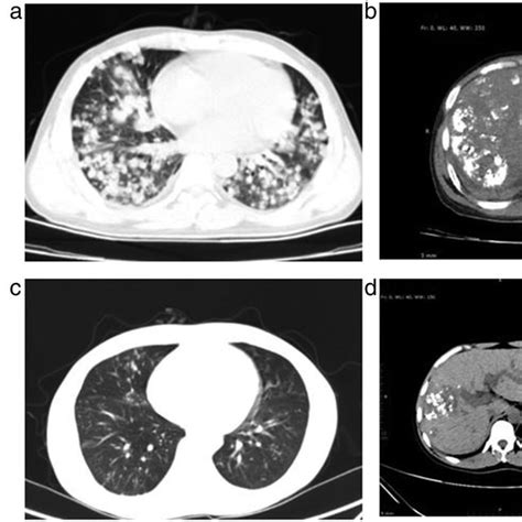 Computed Tomography Ct Scan Before And After Treatment A Chest Ct