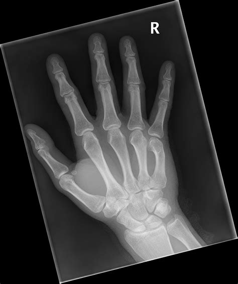 Fifth Metacarpal Fracture Malunion Image