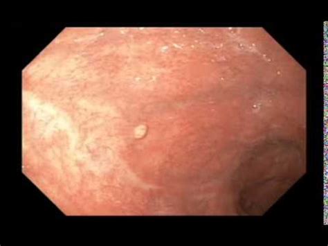 Stomach Benign Findings Submucosal Lesion Video Medtube Net