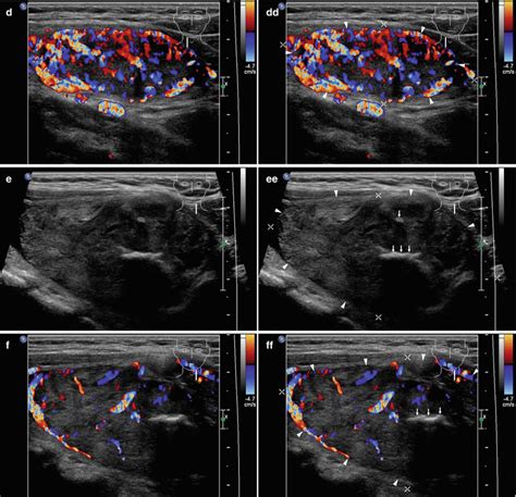 Toxic Multinodular Goiter And Solitary Toxic Adenoma Radiology Key