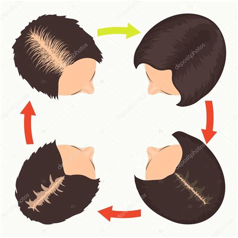 The role testosterone and dht have on hair loss. Female pattern hair loss stages — Image vectorielle Naumas ...