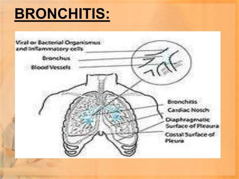 Lower Respiratory Tract Infections Ppt