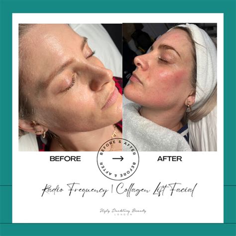 Rejuvenate Your Skin With Collagen Lift A Complete Guide To Radio Fre