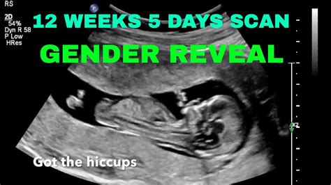 12 Weeks 5 Days Ultrasound Gender Reveal Youtube