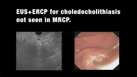 Choledocholithiasis Ercp