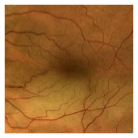 Branch Retinal Artery Occlusion Brao Of A 62 Year Old Man Showing A