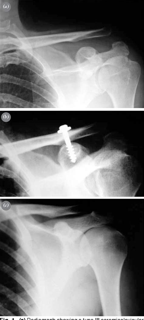 Figure 1 From Coracoclavicular Ligament Repair And Screw Fixation In