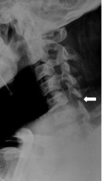 24 Unilateral Facet Dislocation Lateral Cervical Spine Radiograph