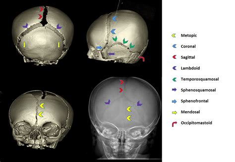 Cranial Sutures