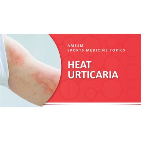 Medicine For Urticaria News And Health