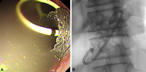 Endoscopic Replacement Technique For Migrated Lumen Apposing Metal