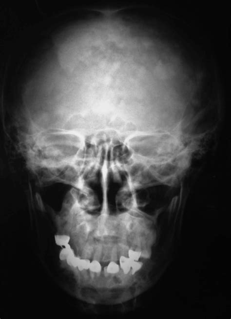 Indicaciones De La Radiografía Posteroanterior Dento Metric