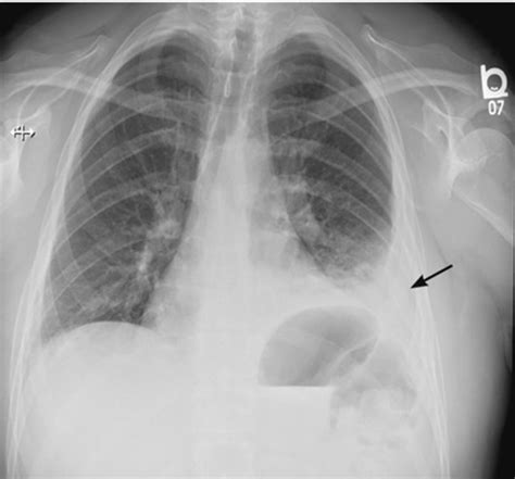 Chest Xray Pleural Effusion