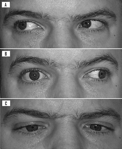 Cluelessmedic — Internuclear Ophtalmoplegia Ino Caused By A