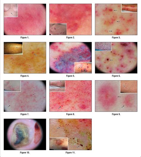Figure 4 From Dermoscopic Patterns Of Purpuric Lesions Semantic Scholar