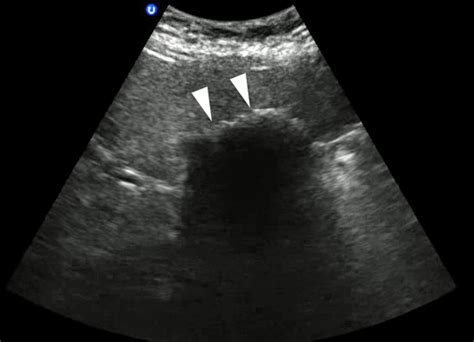 Biliary Images Emergency Ultrasonography