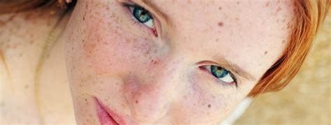 Spots On Face Condition That Requires Sun Spots Treatment Cmc