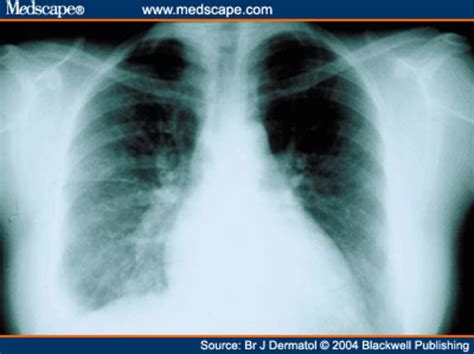 Pleurisy In Chest X Ray Various Radiographs To Show And Depict This