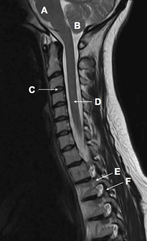 Sagittal T2 Weighted Magnetic Resonance Image Of The Cervical Spine