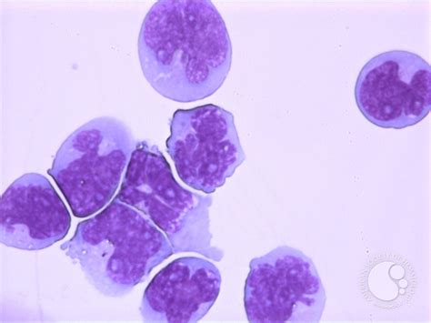 Mantle Cell Lymphoma Csf