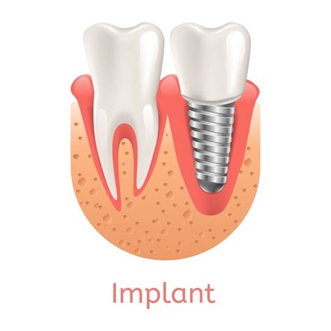 Ilustración Realista De Implante Dental En Gráfico 3d Vector Premium
