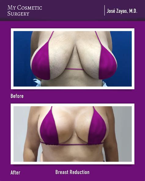 Breast Reduction At My Cosmetic Surgery Miami Cosmetic Surgery Breast Reduction Breast
