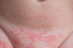 Newborn Rashes and Skin Conditions | Urgent Care for Kids Near Me