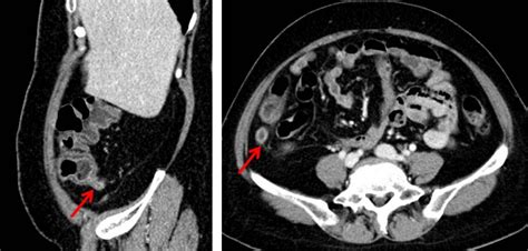 Acute Appendicitis Radiology Cases