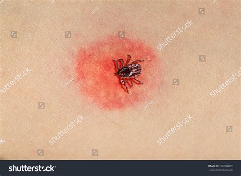 Tick Biting Human Skin Causing Dangerous Stock Photo Edit Now 686984089