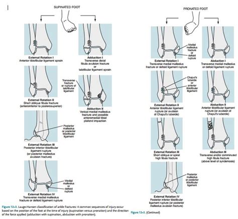 Lauge Hansen Classification System For Ankle Fractures Mr Steve Edwards