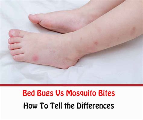 Bed Bugs Vs Mosquito Bites