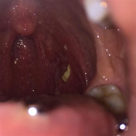 Oddly Enough My Small Tonsil Always Has The Biggest Stones Tonsilstones