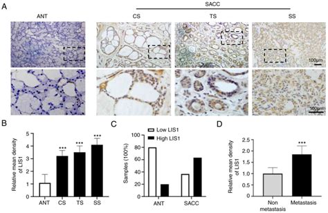 lis1 interacts with clip170 to promote tumor growth and metastasis via the cdc42 signaling