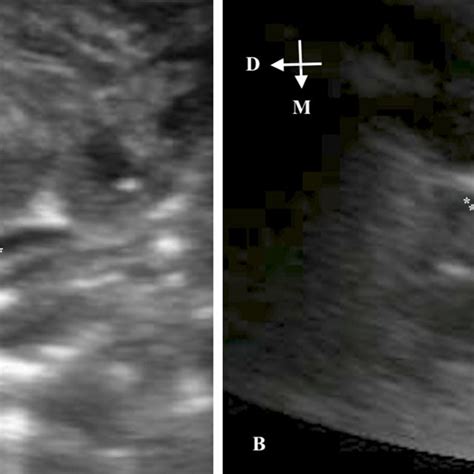 Ultrasound Image Obtained In A Transverse Oblique Plane In A Standing
