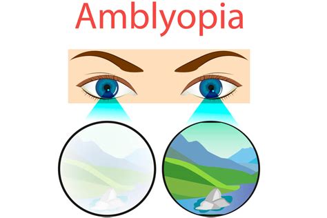 Squint And Amblyopia In Babies Being The Parent