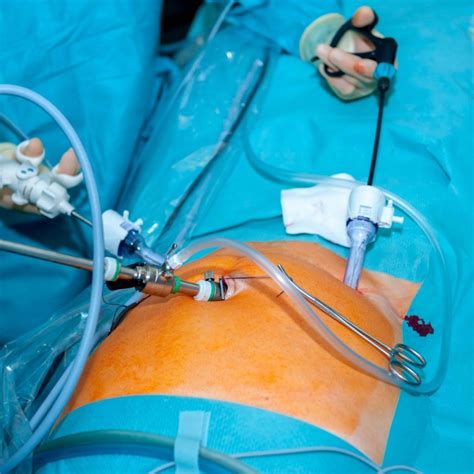 Absolute contraindications for laparoscopic cholecystectomy include the inability to tolerate general anesthesia and uncontrolled coagulopathy. Laparoscopic Hysterectomy | Brisbane Obstetrician ...