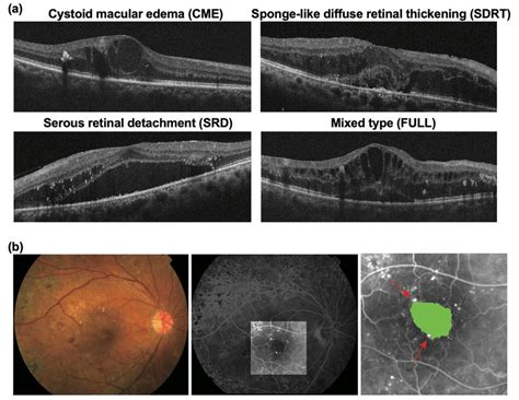 Diabetic Macular Edema Dme Morphology A Representative Optical