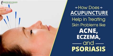 Acupuncture Techniques For Treating Acne Eczema Psoriasis