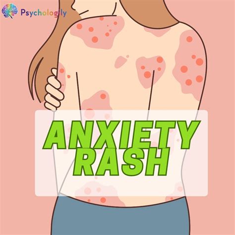 Anxiety Rash Understanding The Link Between Stress And Skin Irritation