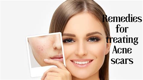 Best Acne Scar Treatments Recommendations From Dermatologists